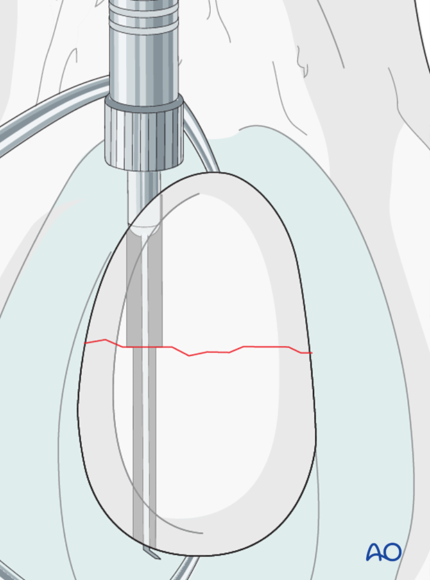 lag screw length measurement