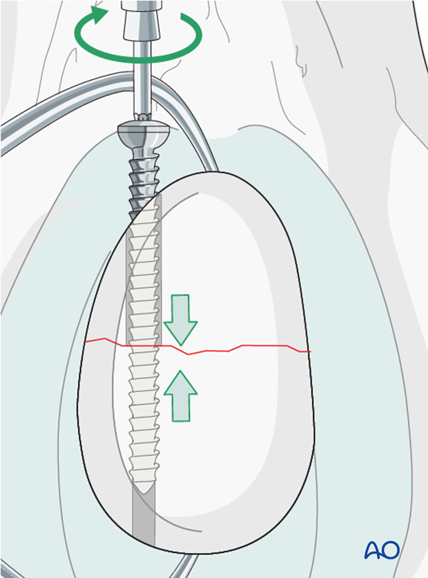 lag screw insertion