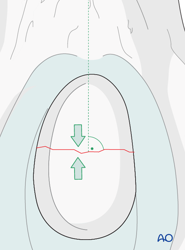 lag screw direction