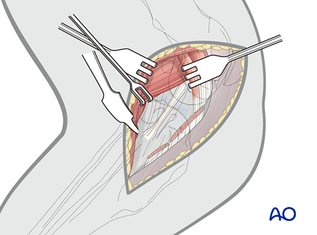 Craniomedial approach used for fractures of the proximal tibial metaphysis