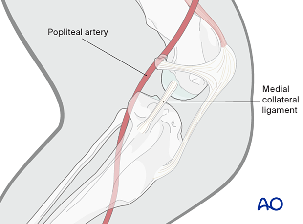 The popliteal artery passes caudal to the tibia.