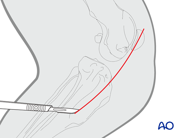 Slightly curved skin incision on the craniomedial surface of the stifle starting at the level of the patella