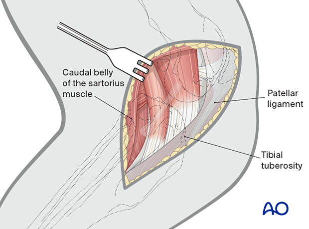 Identification of the patellar ligament and tibial tuberosity after incision of the subcutaneous tissue