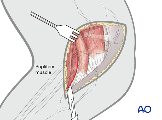 Incision of the insertion of the popliteus muscle on the caudomedial edge of the tibia
