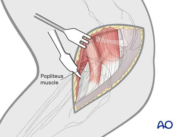 Elevation of the muscle from the tibia