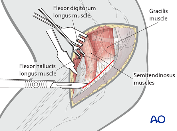 Complete exposure of the tibia caudally