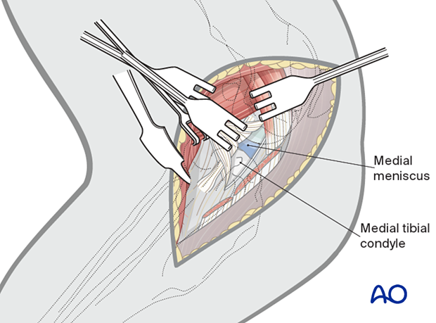 Craniomedial arthrotomy to allow inspection of the meniscus and articular surface of the tibial condyle