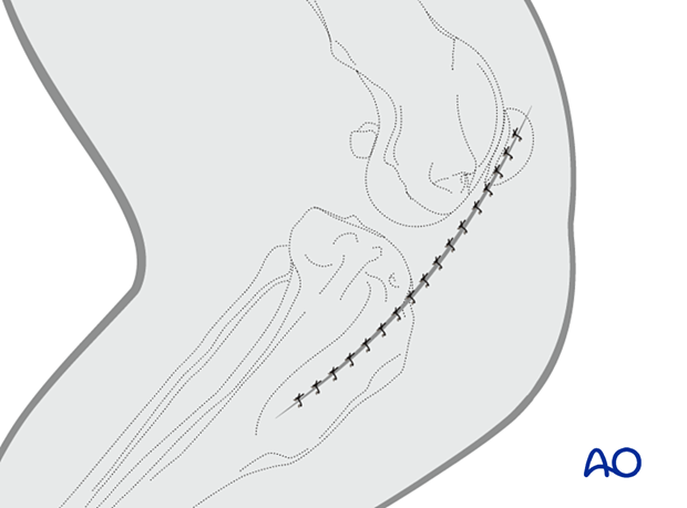 Closure of the incision along the cranial margin of the caudal belly of the sartorius muscle.