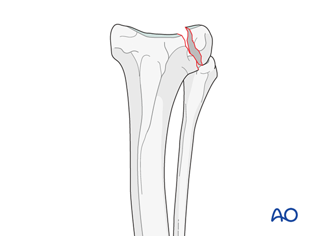 Lateral simple partial articular fracture of the proximal tibia in the dog