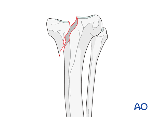 Medial simple partial articular fracture of the proximal tibia in the dog