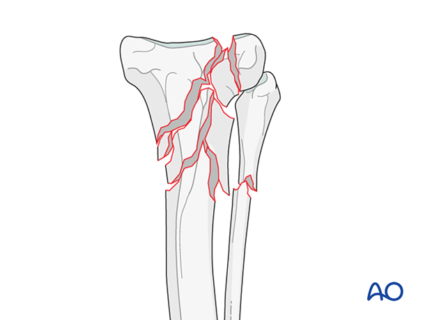 Simple articular, multifragmentary metaphyseal fracture of the proximal tibia in the dog
