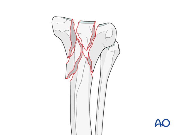 Multifragmentary articular fracture of the proximal tibia in the dog