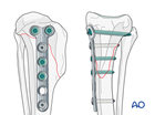 Bone plate fixation