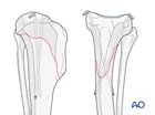 K-wire fixation