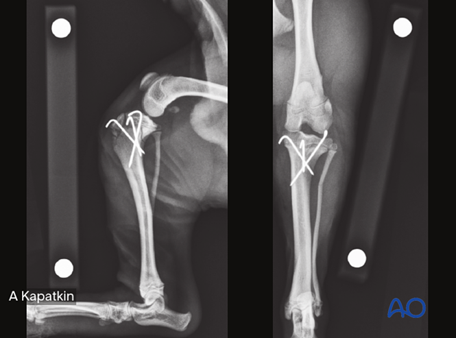 Tibia Wire Guide K-wire fixation for Simple extraarticular fracture