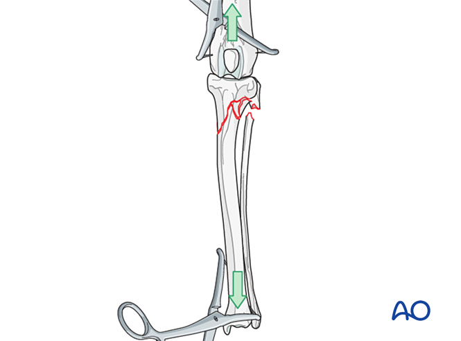 Bridging plate and screw fixation for Multifragmentary extraarticular ...