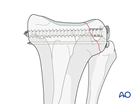 Lag screw and K-wire fixation
