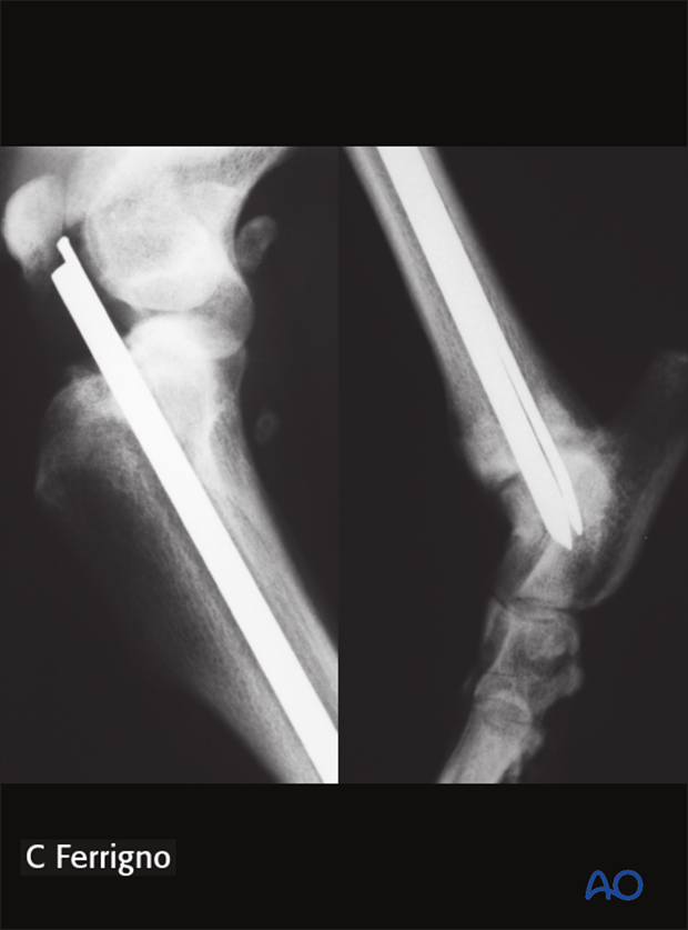 complications with tibial shaft fractures