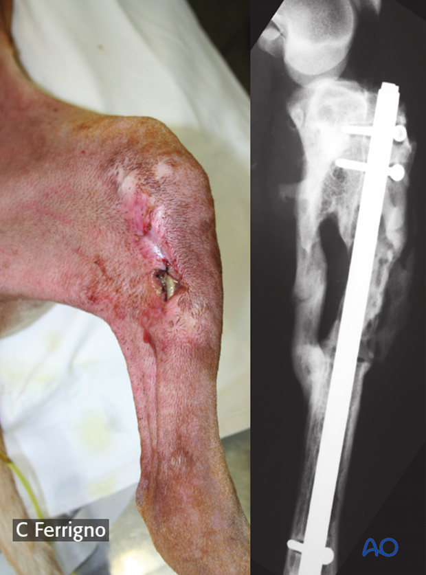 complications with tibial shaft fractures