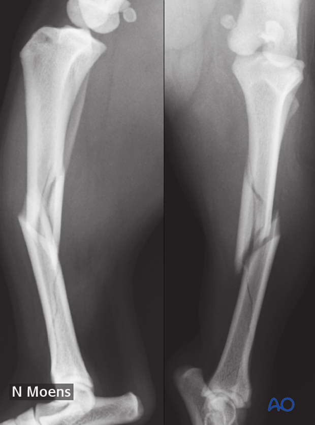 complications with tibial shaft fractures