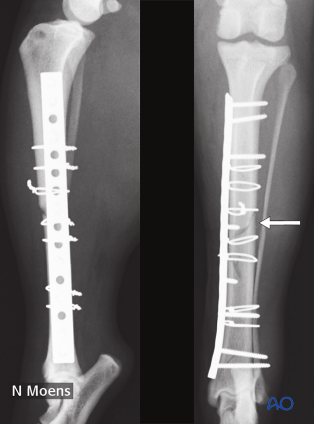 complications with tibial shaft fractures