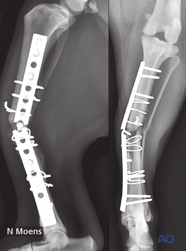 complications with tibial shaft fractures