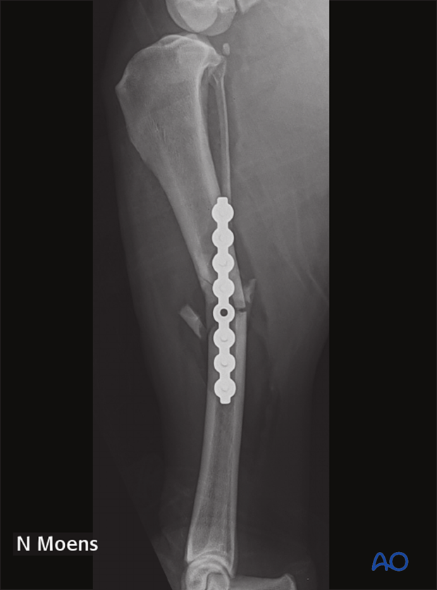 complications with tibial shaft fractures