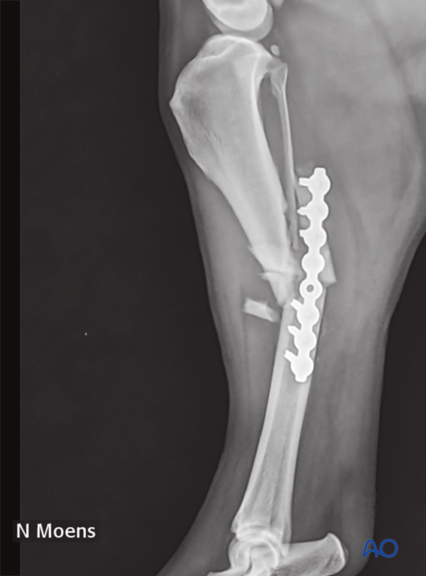 complications with tibial shaft fractures