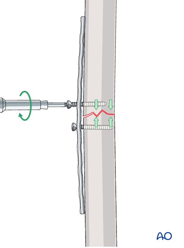 Compression plate for Simple transverse tibial