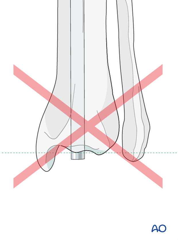 Plate and rod for Complex with nonreducible wedges in the tibial diaphysis