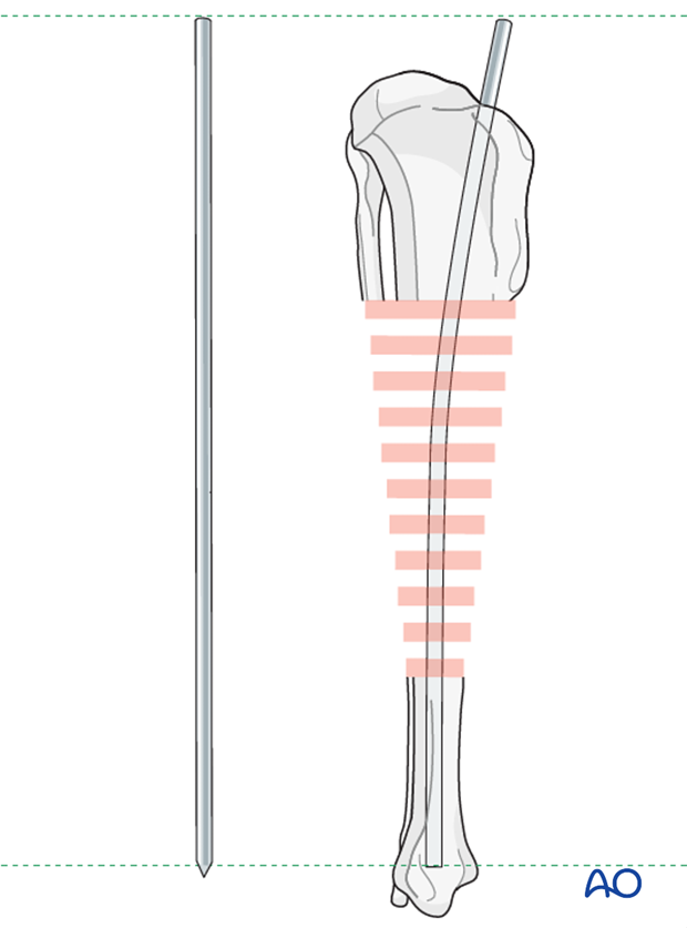 Plate and rod for Nonreducible wedges in the tibial diaphysis