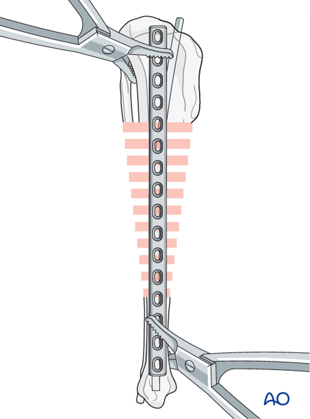 Plate and rod for Several reducible wedges in the tibial diaphysis