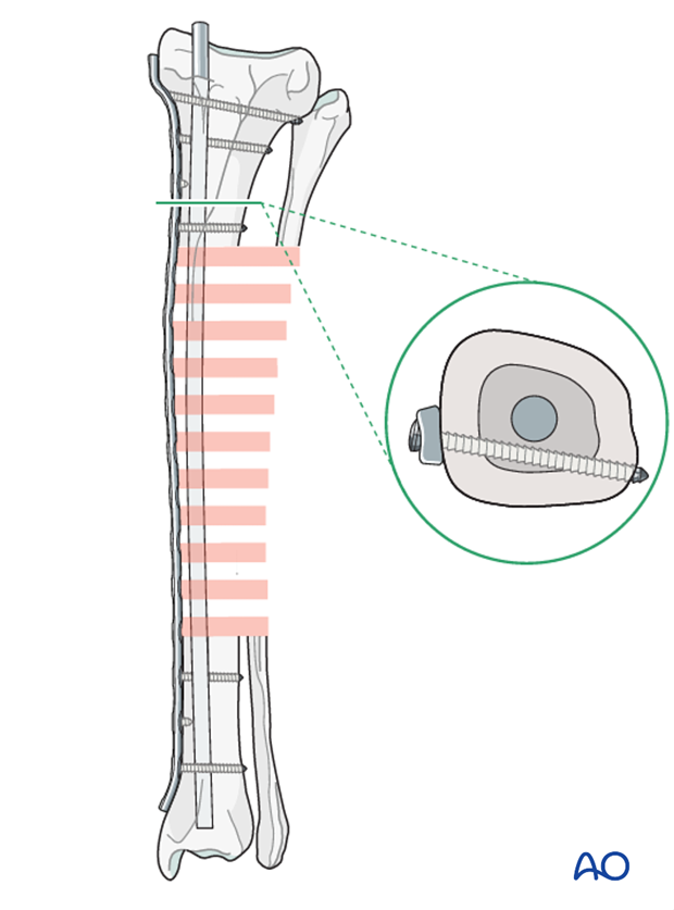 Plate and rod for Complex with nonreducible wedges in the tibial diaphysis