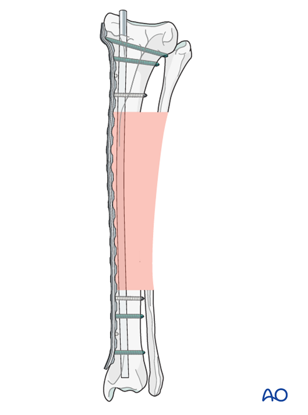Plate and rod for Complex with nonreducible wedges in the tibial diaphysis