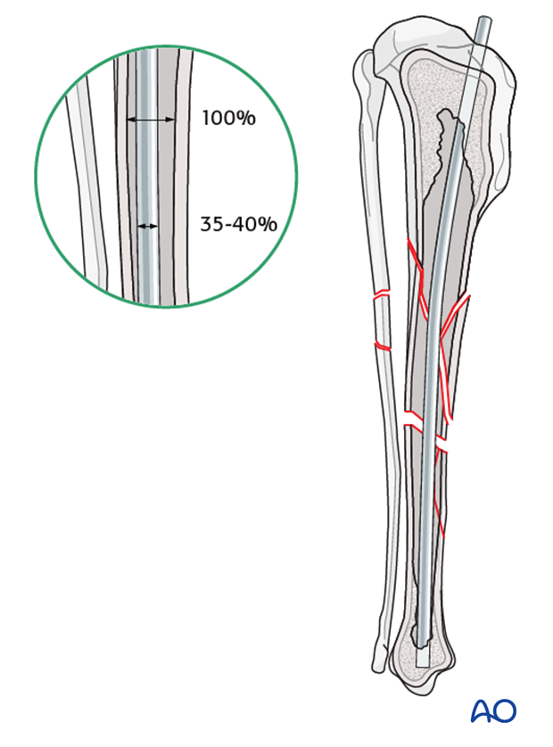 Plate and rod for Complex with reducible wedges in the tibial diaphysis