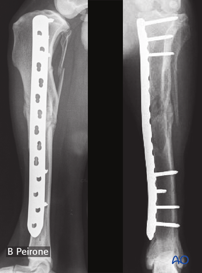 Bridging plate for Complex with nonreducible wedges in the tibial diaphysis