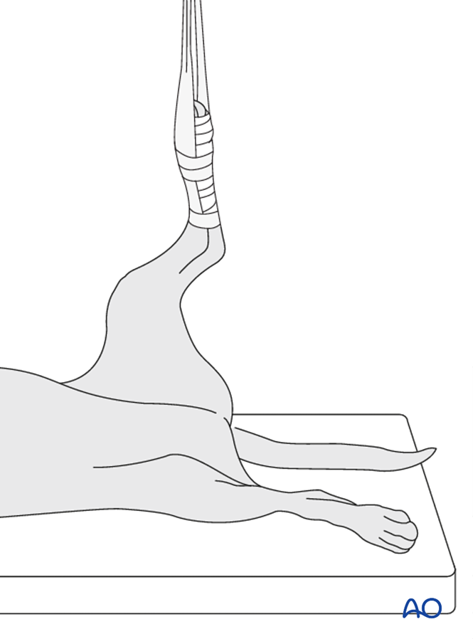 Angled Recumbency Dorsal recumbency (hanging limb)