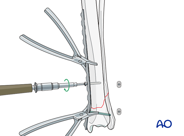 Medial plating for Simple extraarticular fracture of the distal tibia