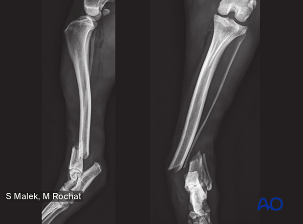 D43_P050_i240 43-A1 grade 1 open fracture in a 5-year-old dog