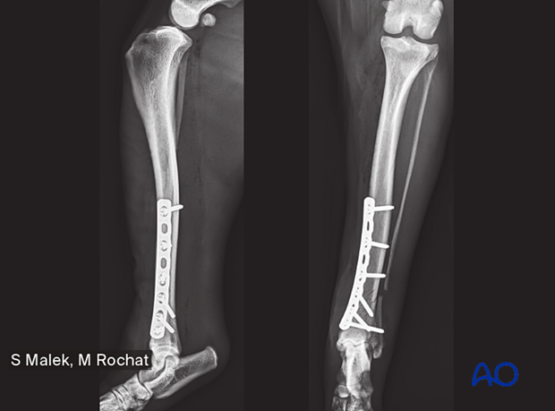 Medial plating for Simple extraarticular fracture of the distal tibia