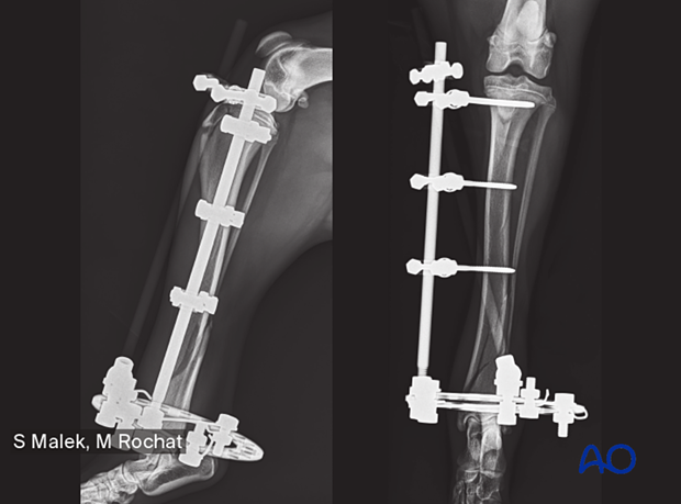 Hybrid external skeletal fixation for Simple extraarticular fracture of ...