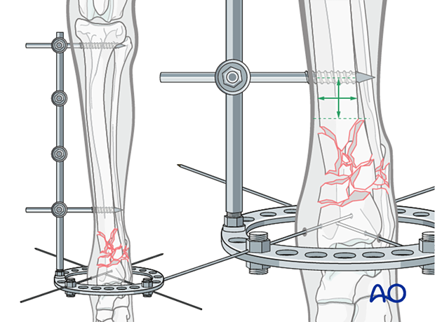 Hybrid external fixation for Complex extraarticular fracture of the ...