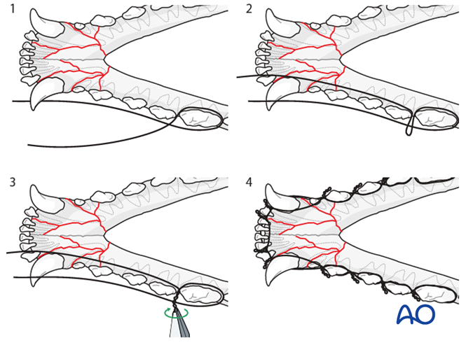 Wire reinforced intraoral splinting for Mandible, Rostral: Bilateral ...