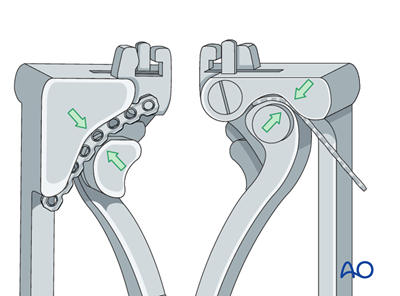 Plate fixation for Mandible, Ramus fractures