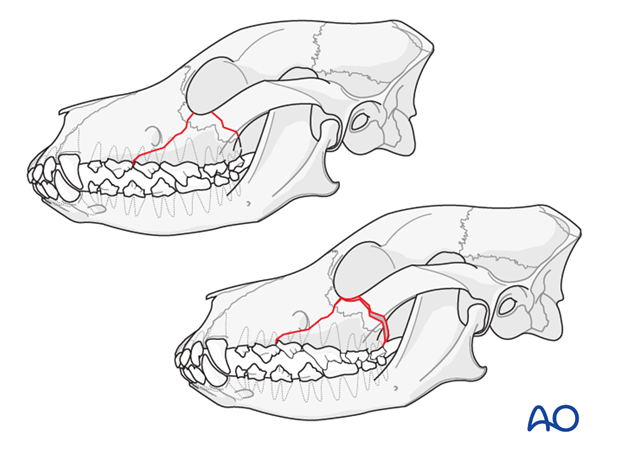 Simple caudal midface fractures