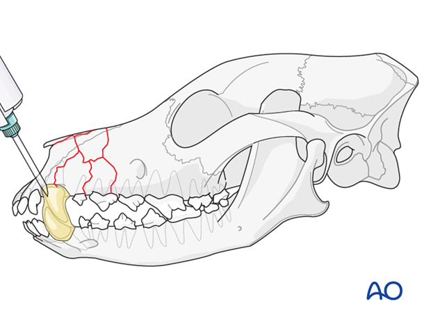 Maxillomandibular fixation for Midface, Rostral: Comminuted