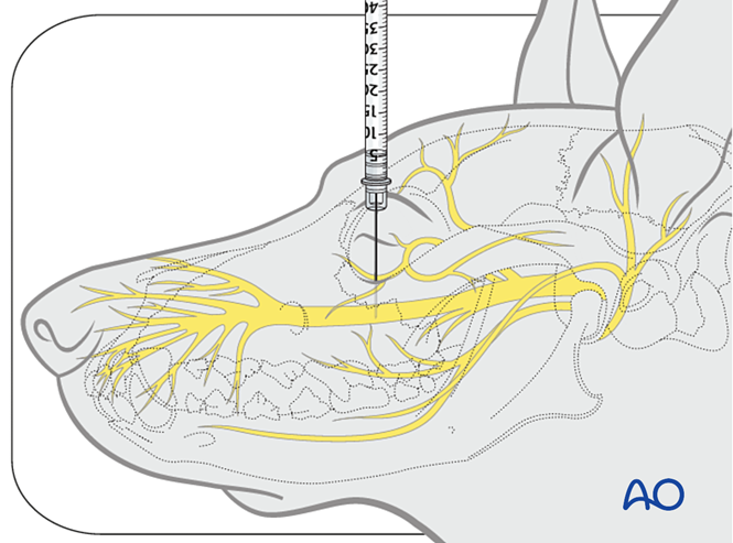 Maxillary nerve block