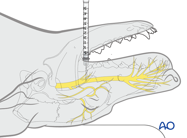 Intraoral approach to the maxillary nerve