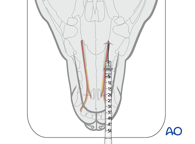 Major palatine foramen approach
