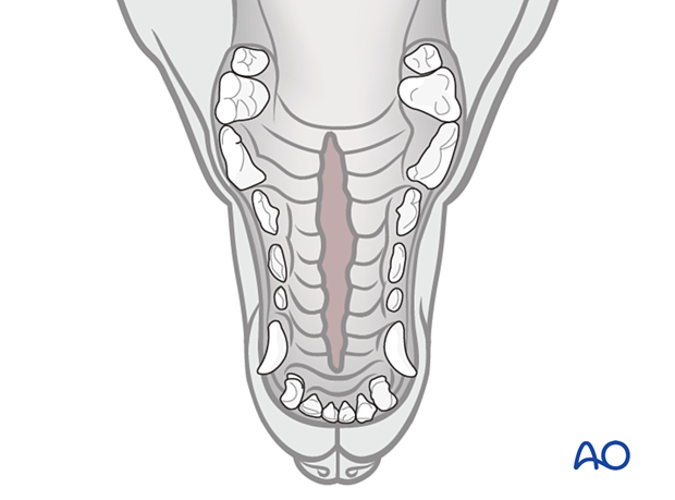 Cleft hard palate